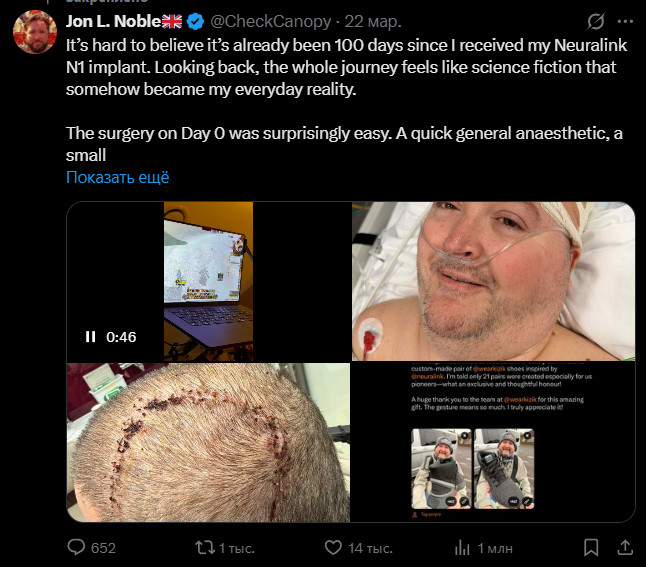 Пациент с имплантом Neuralink играет в World of Warcraft силой мысли